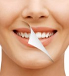הלבנת שיניים WALKING - תמונת המחשה